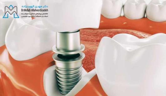 مزایای ایمپلنت دندان