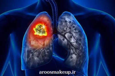 علایم سرطان ریه را بشناسید
