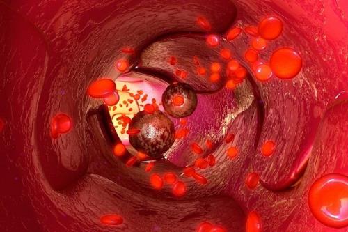 لیپوپروتئین ریسک مبتلا شدن به سرطان پروستات را زیاد می کند