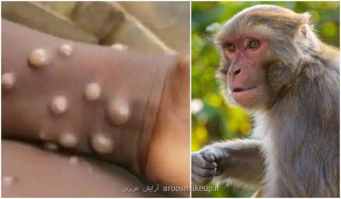 نشانه های مبتلا شدن به آبله میمون