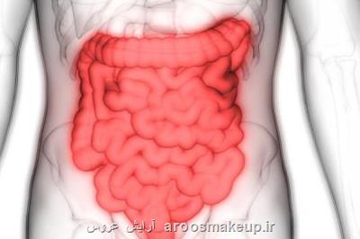 ارتباط بیماری التهابی روده با ریسک حاملگی های پرخطر