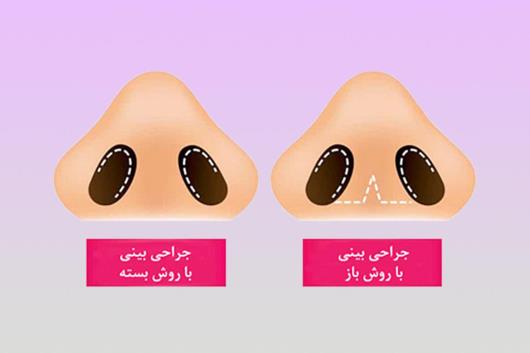 مقایسه کامل روش های باز و بسته جراحی بینی