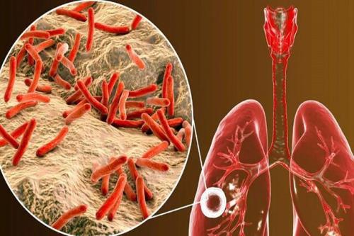 آشنایی با بیماری سل و پیش گیری از مبتلاشدن به آن