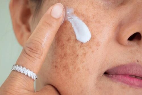هشدار مراقب سوختگی های پنهان آفتاب باشید
