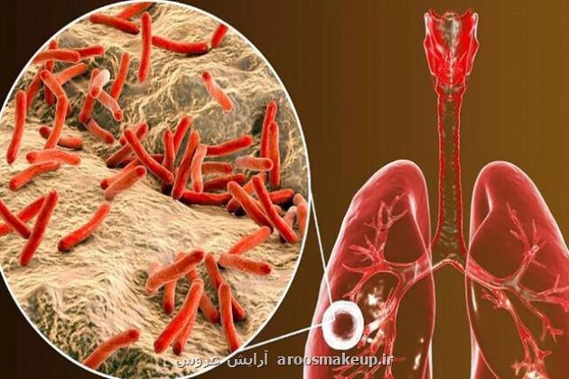 آشنایی با بیماری سل و پیش گیری از مبتلاشدن به آن