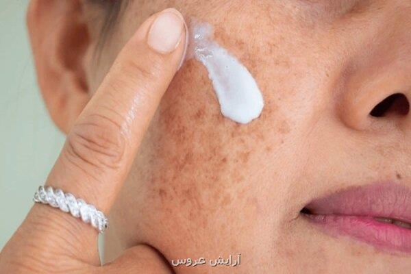 هشدار مراقب سوختگی های پنهان آفتاب باشید