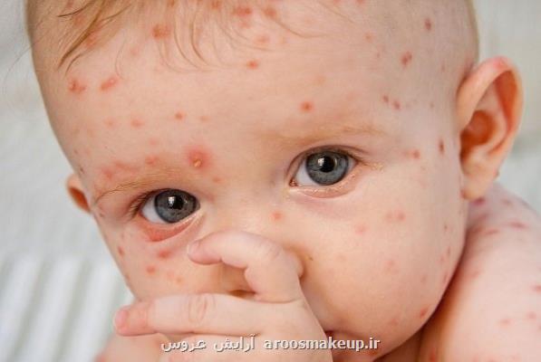 ابتلای خردسالان به آبله مرغان خطرناک نیست
