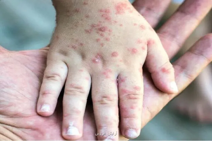 ثبت 714 مورد سرخک در کشور اوج مبتلاشدن در اردیبهشت