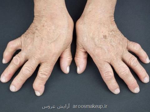 خطر در كمین كودكان متولد شده از مادران مبتلا به آرتریت روماتوئید