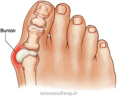 علت انحراف شست پا چیست؟