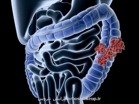 شمار جوانان مبتلا به سرطان روده در جهان افزایش یافته است