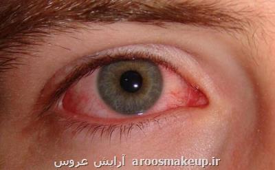 عارضه چشم صورتی علامت بیماری كرونا است