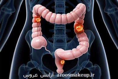 مصرف آسپرین در پیش گیری از سرطان روده در بزرگسالان تاثیر ندارد